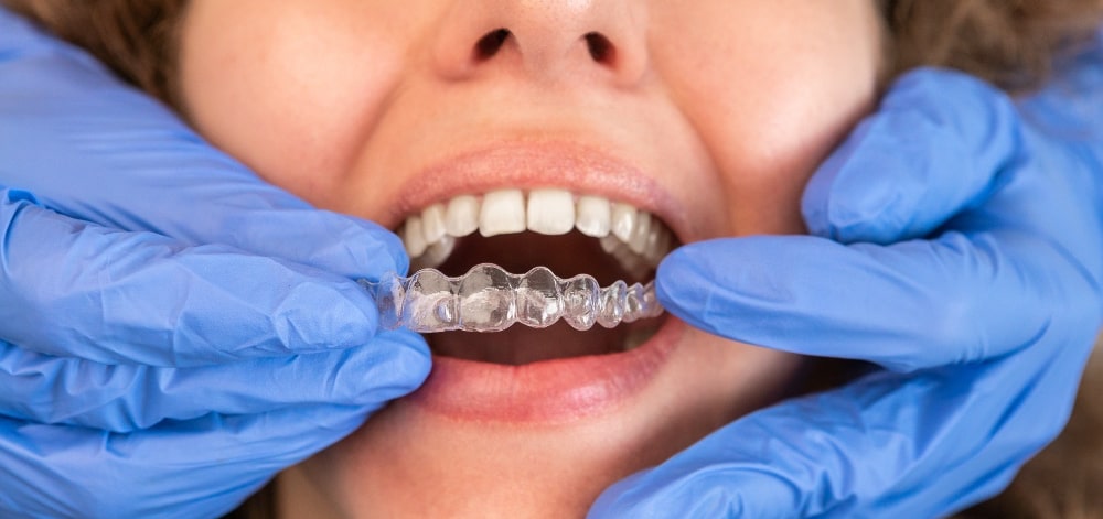 Custom Night & Sports Guards