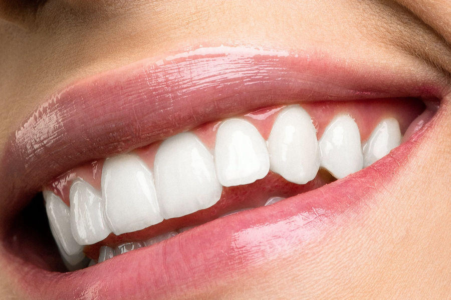 Teeth Cleanings